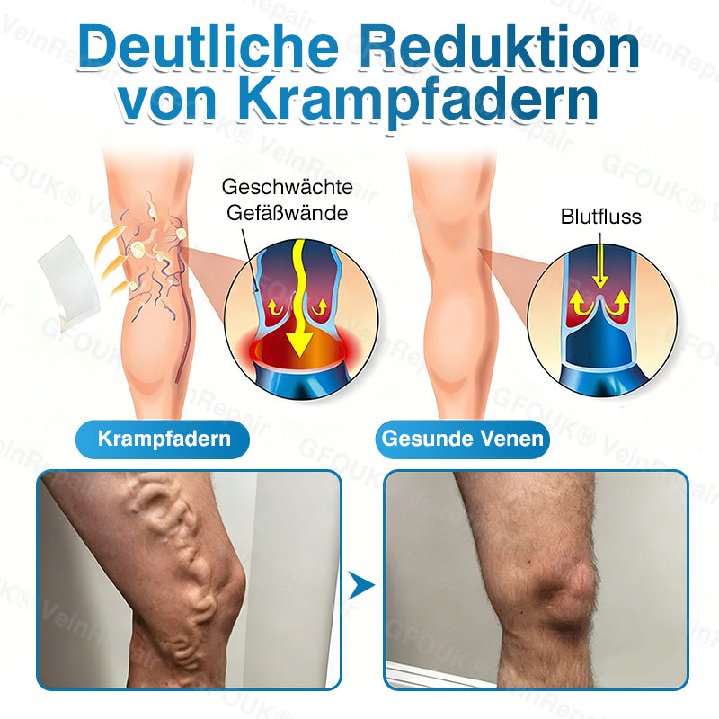 🇩🇪🏆✅️👨‍⚕️GFOUK® VeinRepair Mikronadel-Pflasterrolle⚡Sofortige Linderung, langfristige Ergebnisse