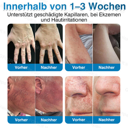 🇩🇪🏆✅️👨‍⚕️GFOUK® VeinRepair Mikronadel-Pflasterrolle⚡Sofortige Linderung, langfristige Ergebnisse