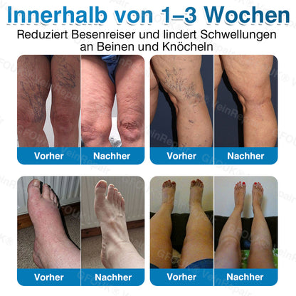 🇩🇪🏆✅️👨‍⚕️GFOUK® VeinRepair Mikronadel-Pflasterrolle⚡Sofortige Linderung, langfristige Ergebnisse