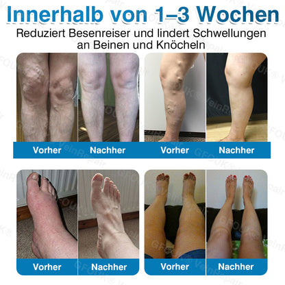 🇩🇪✅GFOUK® VeinRepair Mikronadel-Pflasterrolle⚡Sofortige Linderung, langfristige Ergebnisse
