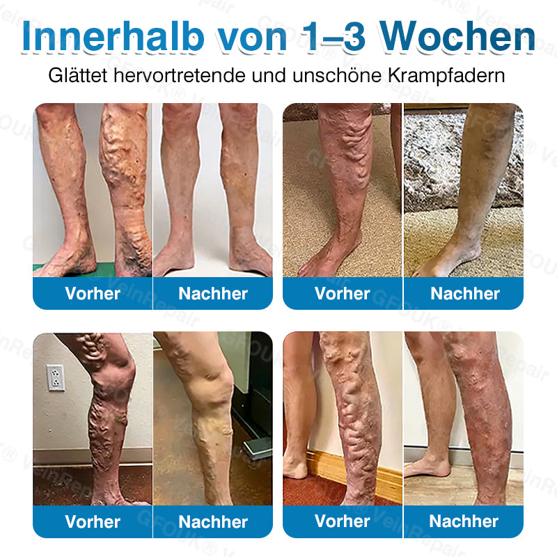 🇩🇪🏆✅️👨‍⚕️GFOUK® VeinRepair Mikronadel-Pflasterrolle⚡Sofortige Linderung, langfristige Ergebnisse