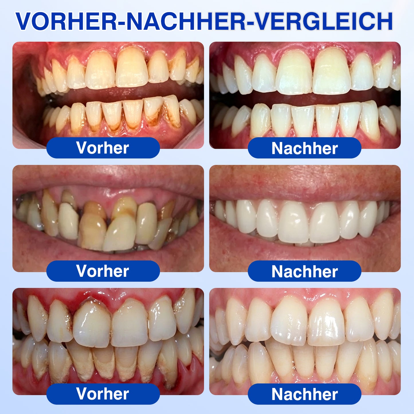 🇩🇪👨‍⚕️✅😁Evolvion® GumRevive Parodontales Reparaturgel
