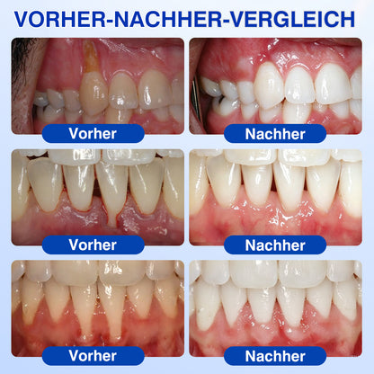 🇩🇪👨‍⚕️✅😁Evolvion® GumRevive Parodontales Reparaturgel