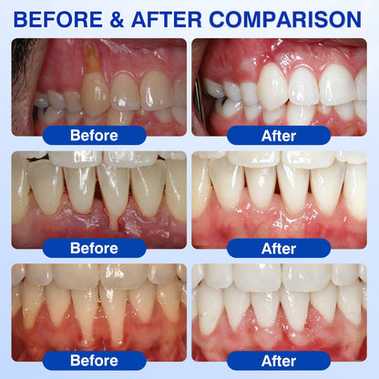 👨‍⚕️✅😁Evolvion® GumRevive Periodontal Repair Gel