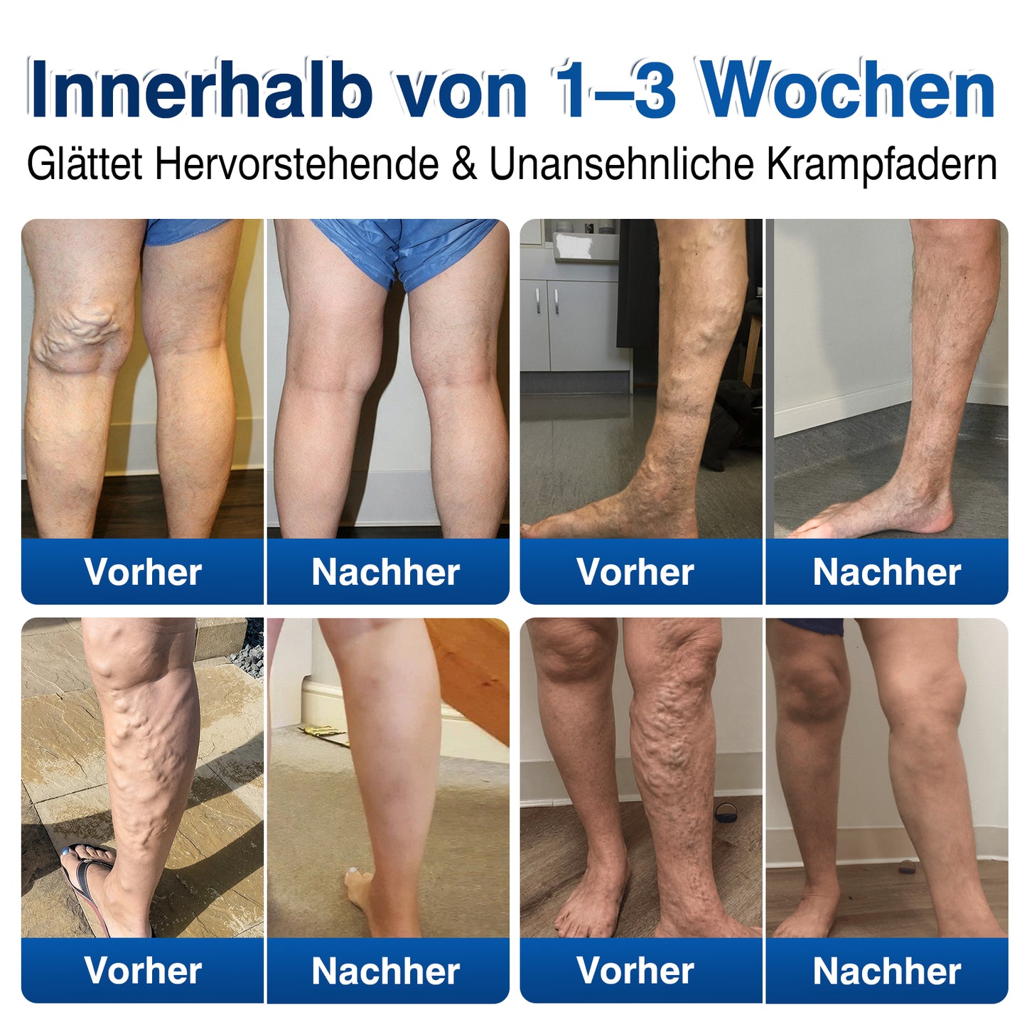 🇩🇪🎁GFOUK®VeinRenew Mikronadel-Balsam