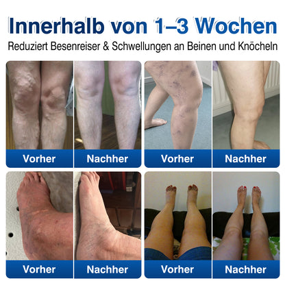 🇩🇪🎁GFOUK®VeinRenew Mikronadel-Balsam
