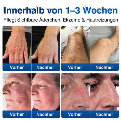 🇩🇪🎁GFOUK®VeinRenew Mikronadel-Balsam