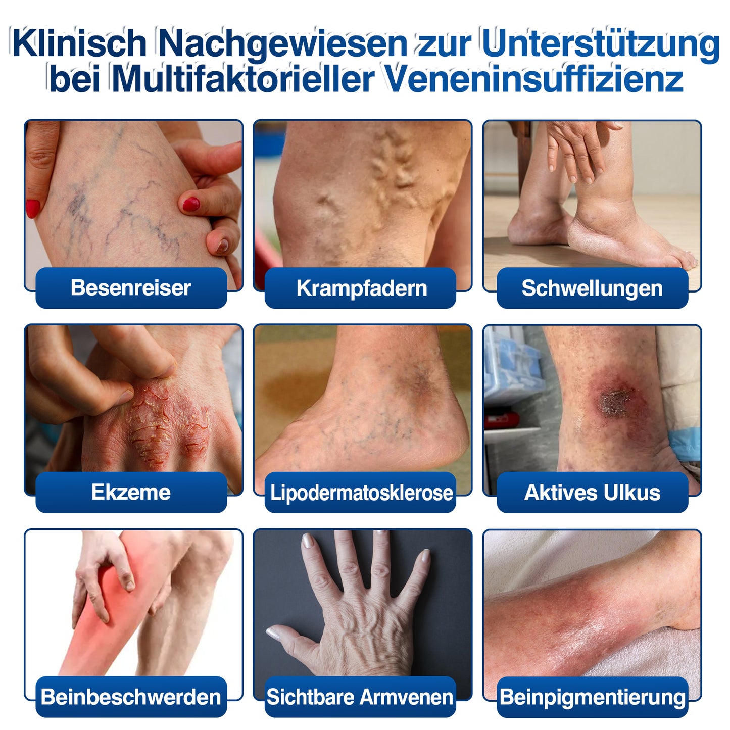 🇩🇪🎁GFOUK®VeinRenew Mikronadel-Balsam