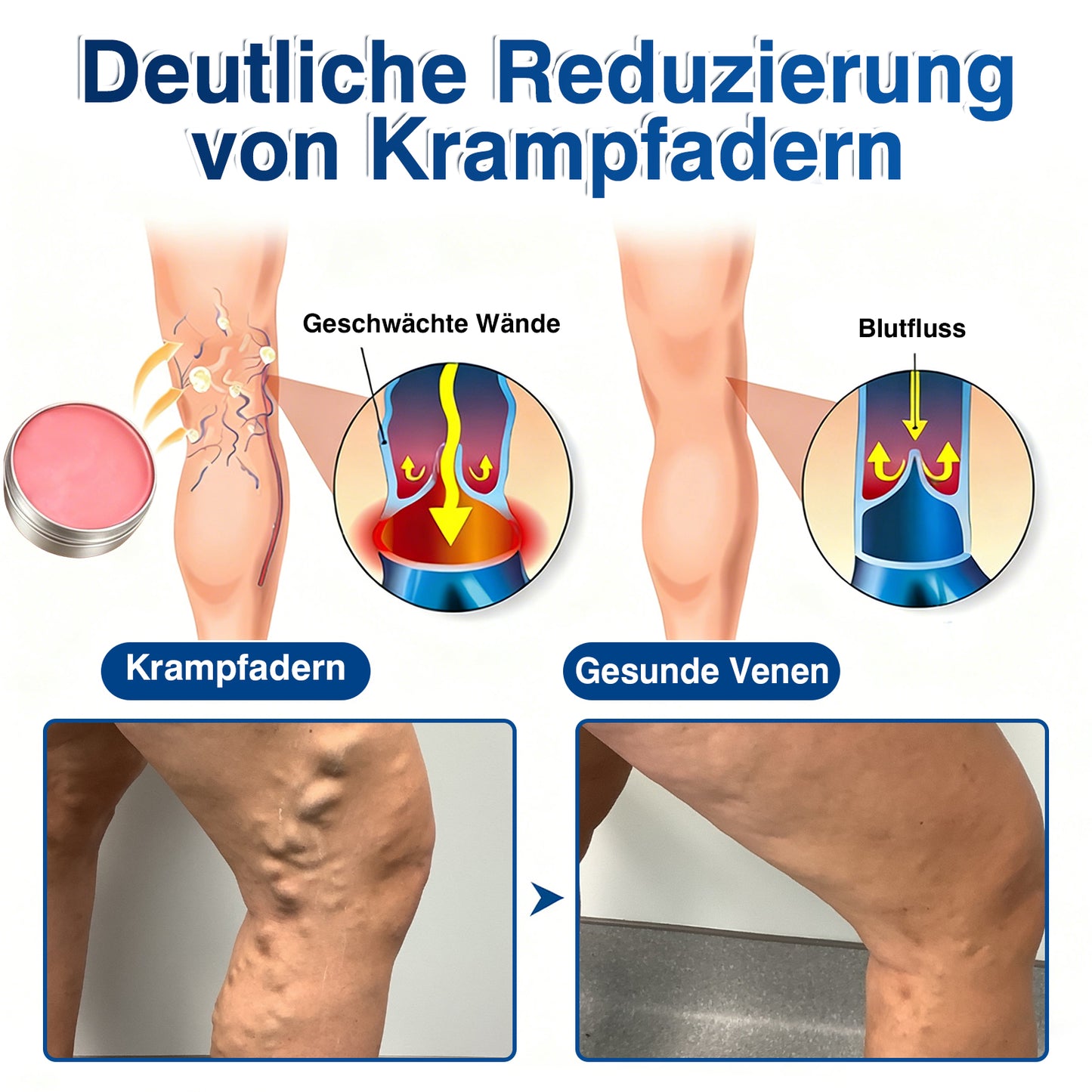 🇩🇪🎁GFOUK®VeinRenew Mikronadel-Balsam