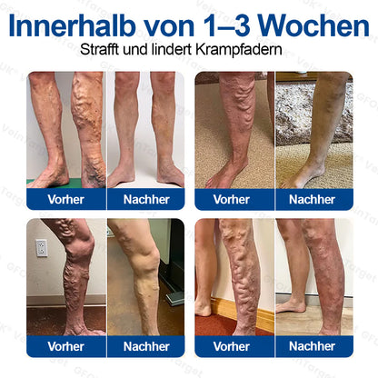 🇩🇪👨‍⚕️✅✅GFOUK® VeinTarget Mikronadel-Pflaster⚡Sofortige Linderung, langfristige Ergebnisse