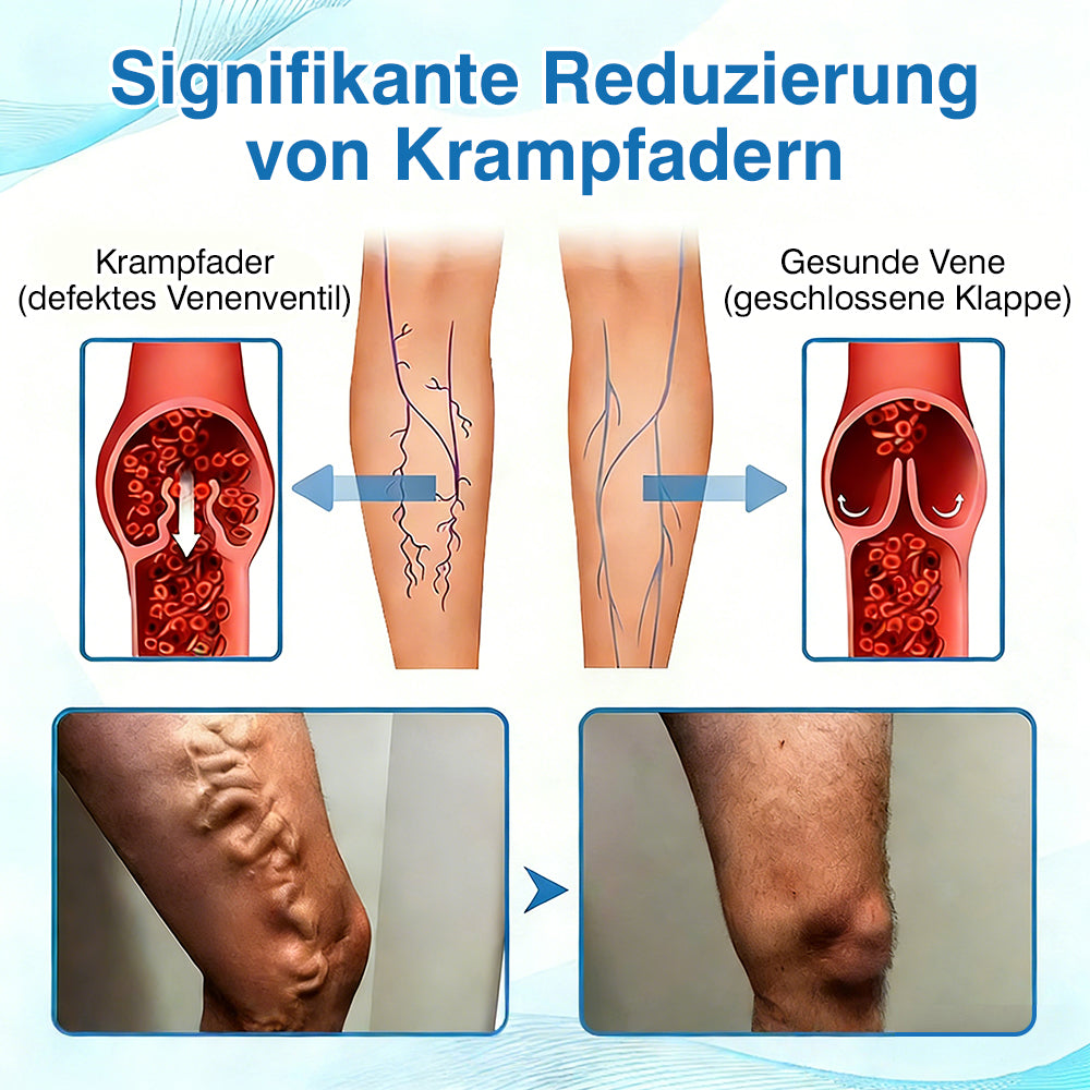 🇩🇪🎁GFOUK® VascuCare Vein Healing Spray(Entwickelt für Krampfadern, Besenreiser, tiefe Venenthrombose (TVT), chronische venöse Insuffizienz, venöse Geschwüre, Thrombophlebitis und andere venöse Beschwerden)