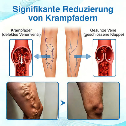 🇩🇪🎁GFOUK® VascuCare Vein Healing Spray(Entwickelt für Krampfadern, Besenreiser, tiefe Venenthrombose (TVT), chronische venöse Insuffizienz, venöse Geschwüre, Thrombophlebitis und andere venöse Beschwerden)
