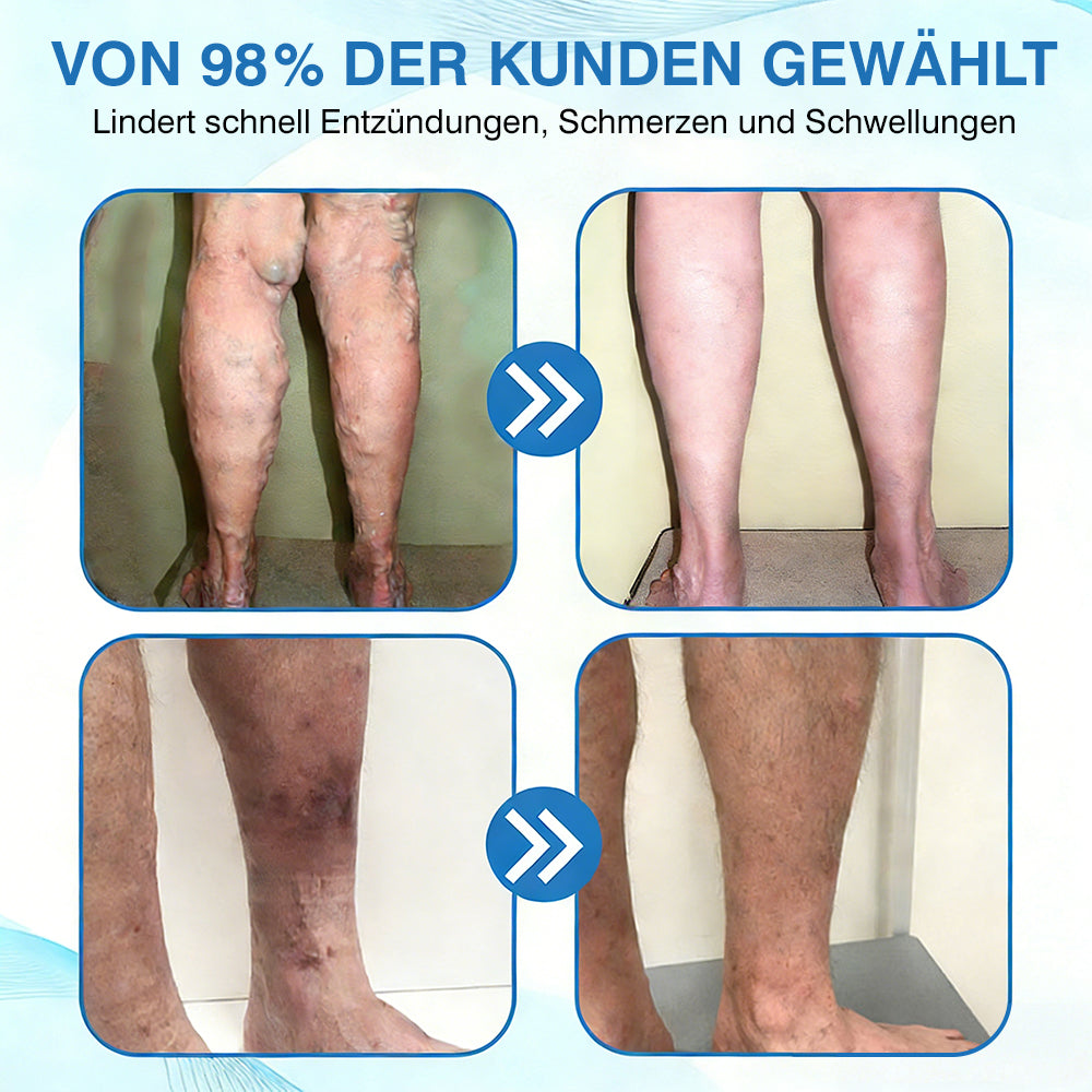 🇩🇪🎁GFOUK® VascuCare Vein Healing Spray(Entwickelt für Krampfadern, Besenreiser, tiefe Venenthrombose (TVT), chronische venöse Insuffizienz, venöse Geschwüre, Thrombophlebitis und andere venöse Beschwerden)