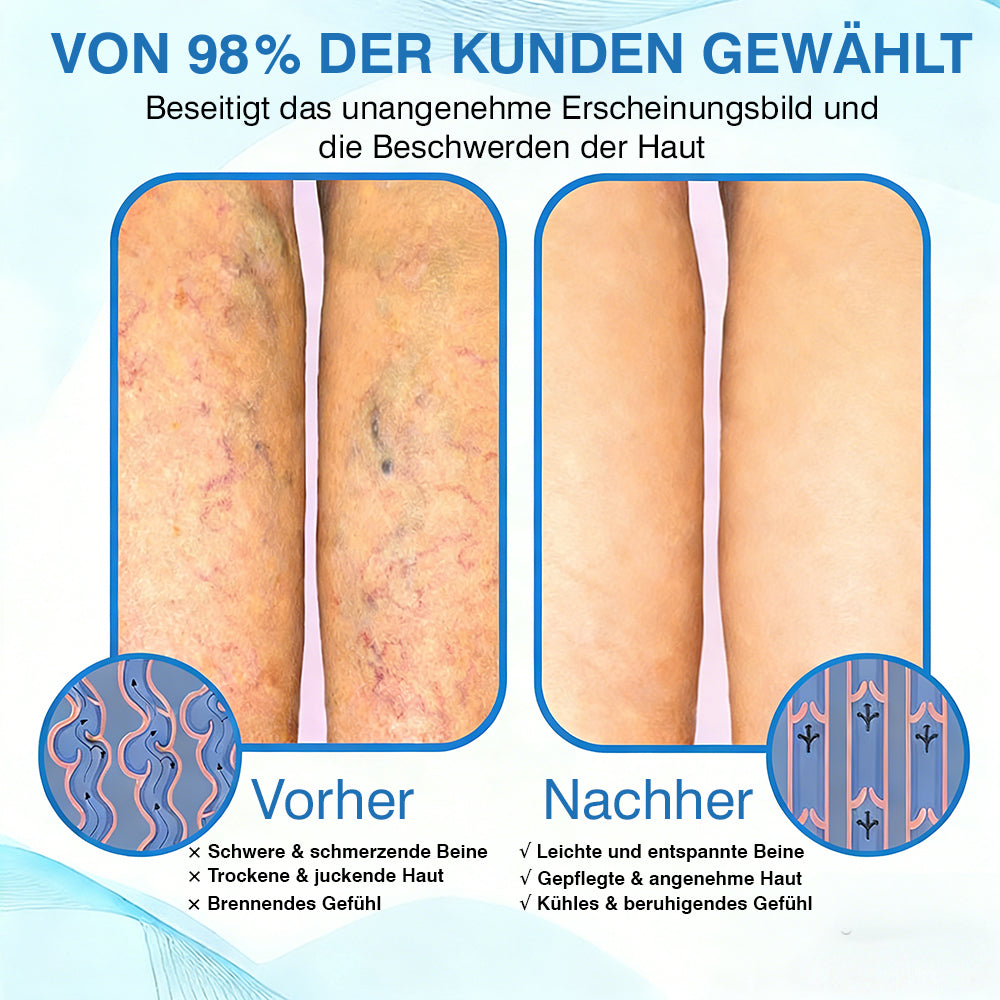🇩🇪🎁GFOUK® VascuCare Vein Healing Spray(Entwickelt für Krampfadern, Besenreiser, tiefe Venenthrombose (TVT), chronische venöse Insuffizienz, venöse Geschwüre, Thrombophlebitis und andere venöse Beschwerden)