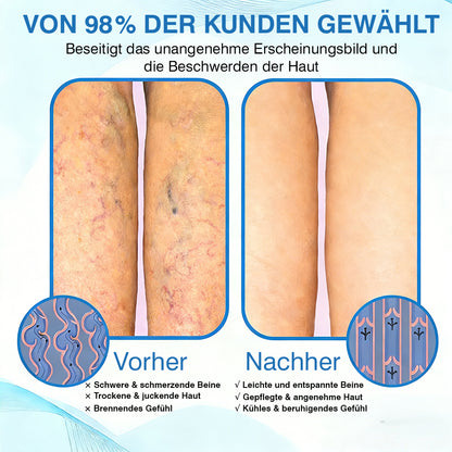 🇩🇪🎁GFOUK® VascuCare Vein Healing Spray(Entwickelt für Krampfadern, Besenreiser, tiefe Venenthrombose (TVT), chronische venöse Insuffizienz, venöse Geschwüre, Thrombophlebitis und andere venöse Beschwerden)