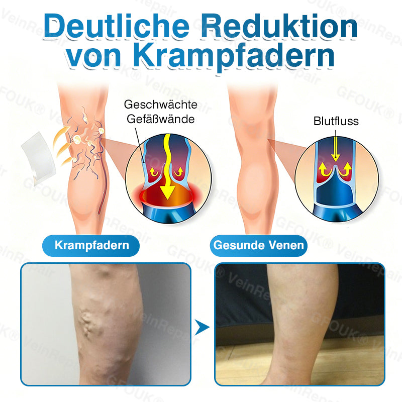 🇩🇪✅GFOUK® VeinRepair Mikronadel-Pflasterrolle⚡Sofortige Linderung, langfristige Ergebnisse